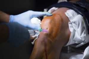 Anaesthetic is injected into a patients knee. 