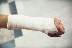 A fractured arm wrapped in a plaster cast