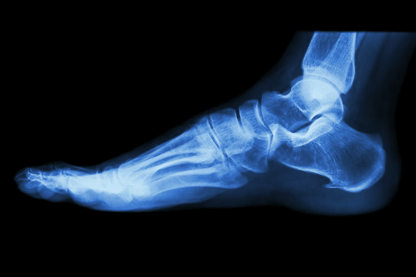 broken foot x ray